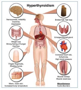 What is Hyperthyroidism