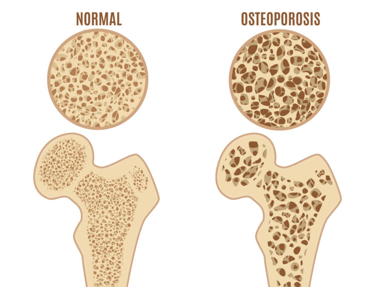Comparison - Normal Bone and Bone with Osteoporosis